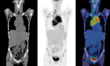 Images:  Pre-treatment image of a patient with uptake in a mediastinal mass (Photo courtesy of Dr. Sally Barrington, London’s St. Thomas’ PET Imaging Center, UK).